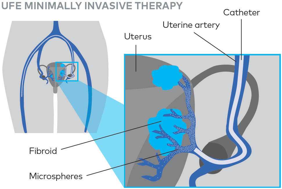 ufe diagram